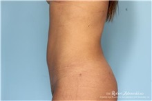 Liposuction After Photo by Robert Zubowski, MD; Paramus, NJ - Case 34486