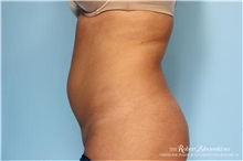 Liposuction Before Photo by Robert Zubowski, MD; Paramus, NJ - Case 34486