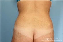 Liposuction After Photo by Robert Zubowski, MD; Paramus, NJ - Case 34487