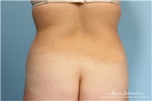 Liposuction Before Photo by Robert Zubowski, MD; Paramus, NJ - Case 34487