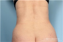 Liposuction After Photo by Robert Zubowski, MD; Paramus, NJ - Case 34488