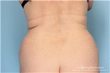 Liposuction Before Photo by Robert Zubowski, MD; Paramus, NJ - Case 34488