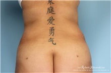 Liposuction After Photo by Robert Zubowski, MD; Paramus, NJ - Case 34489