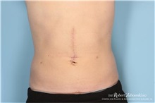 Liposuction After Photo by Robert Zubowski, MD; Paramus, NJ - Case 34490