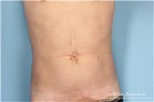 Liposuction Before Photo by Robert Zubowski, MD; Paramus, NJ - Case 34490