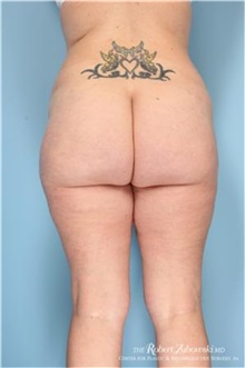 Liposuction After Photo by Robert Zubowski, MD; Paramus, NJ - Case 34491