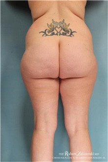 Liposuction Before Photo by Robert Zubowski, MD; Paramus, NJ - Case 34491