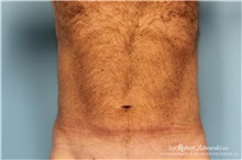 Liposuction After Photo by Robert Zubowski, MD; Paramus, NJ - Case 34492