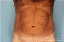 Liposuction Before Photo by Robert Zubowski, MD; Paramus, NJ - Case 34492