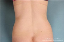 Liposuction After Photo by Robert Zubowski, MD; Paramus, NJ - Case 34493