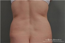 Liposuction Before Photo by Robert Zubowski, MD; Paramus, NJ - Case 34493