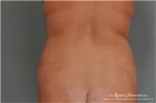 Liposuction Before Photo by Robert Zubowski, MD; Paramus, NJ - Case 34494