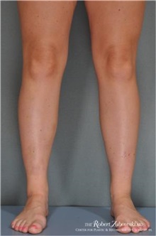 Liposuction After Photo by Robert Zubowski, MD; Paramus, NJ - Case 34495