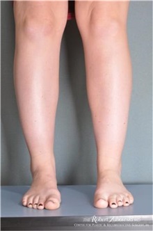 Liposuction Before Photo by Robert Zubowski, MD; Paramus, NJ - Case 34495