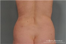 Liposuction After Photo by Robert Zubowski, MD; Paramus, NJ - Case 34496