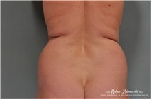 Liposuction Before Photo by Robert Zubowski, MD; Paramus, NJ - Case 34496