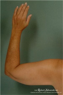 Liposuction After Photo by Robert Zubowski, MD; Paramus, NJ - Case 34497