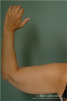Liposuction Before Photo by Robert Zubowski, MD; Paramus, NJ - Case 34497