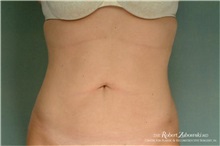 Liposuction After Photo by Robert Zubowski, MD; Paramus, NJ - Case 34498