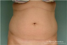 Liposuction Before Photo by Robert Zubowski, MD; Paramus, NJ - Case 34498