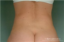 Liposuction After Photo by Robert Zubowski, MD; Paramus, NJ - Case 34499
