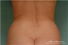 Liposuction Before Photo by Robert Zubowski, MD; Paramus, NJ - Case 34499