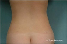 Liposuction After Photo by Robert Zubowski, MD; Paramus, NJ - Case 34500