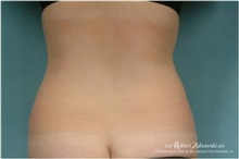 Liposuction Before Photo by Robert Zubowski, MD; Paramus, NJ - Case 34500