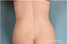 Liposuction After Photo by Robert Zubowski, MD; Paramus, NJ - Case 34501