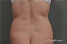 Liposuction Before Photo by Robert Zubowski, MD; Paramus, NJ - Case 34501