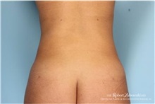 Liposuction After Photo by Robert Zubowski, MD; Paramus, NJ - Case 34502