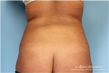 Liposuction Before Photo by Robert Zubowski, MD; Paramus, NJ - Case 34502