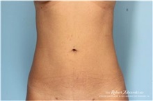 Liposuction After Photo by Robert Zubowski, MD; Paramus, NJ - Case 34504