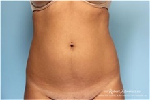 Liposuction Before Photo by Robert Zubowski, MD; Paramus, NJ - Case 34504