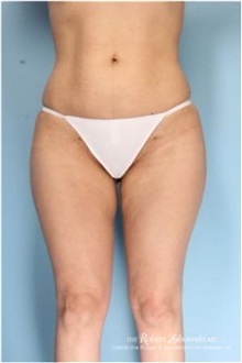 Liposuction After Photo by Robert Zubowski, MD; Paramus, NJ - Case 34506