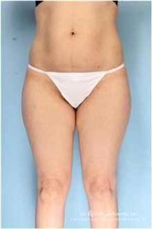 Liposuction Before Photo by Robert Zubowski, MD; Paramus, NJ - Case 34506