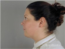 Liposuction After Photo by Robert Zubowski, MD; Paramus, NJ - Case 34508