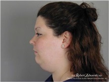 Liposuction Before Photo by Robert Zubowski, MD; Paramus, NJ - Case 34508