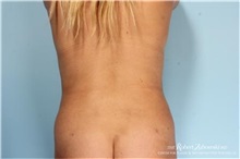 Liposuction After Photo by Robert Zubowski, MD; Paramus, NJ - Case 34509