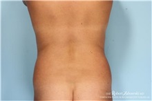 Liposuction Before Photo by Robert Zubowski, MD; Paramus, NJ - Case 34509