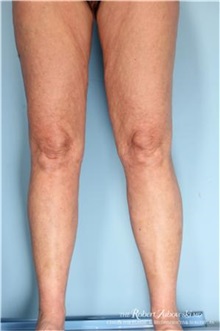 Liposuction After Photo by Robert Zubowski, MD; Paramus, NJ - Case 34510