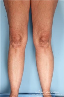 Liposuction Before Photo by Robert Zubowski, MD; Paramus, NJ - Case 34510