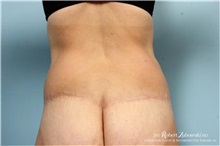Liposuction After Photo by Robert Zubowski, MD; Paramus, NJ - Case 34512