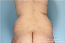 Liposuction Before Photo by Robert Zubowski, MD; Paramus, NJ - Case 34512