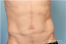 Scar Revision After Photo by Robert Zubowski, MD; Paramus, NJ - Case 34536