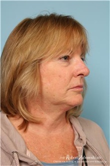 Head and Neck Skin Cancer Reconstruction After Photo by Robert Zubowski, MD; Paramus, NJ - Case 34543