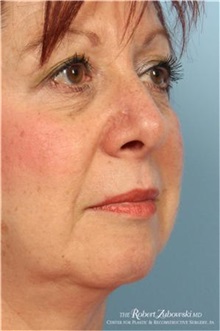 Head and Neck Skin Cancer Reconstruction After Photo by Robert Zubowski, MD; Paramus, NJ - Case 34544