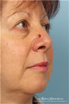 Head and Neck Skin Cancer Reconstruction Before Photo by Robert Zubowski, MD; Paramus, NJ - Case 34544