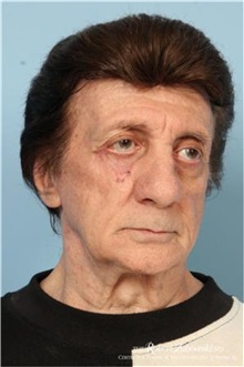 Head and Neck Skin Cancer Reconstruction After Photo by Robert Zubowski, MD; Paramus, NJ - Case 34546