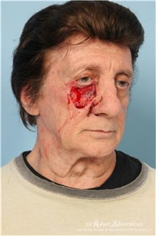 Head and Neck Skin Cancer Reconstruction Before Photo by Robert Zubowski, MD; Paramus, NJ - Case 34546